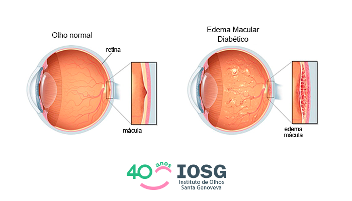 Descolamento de Retina - Instituto de Moléstias Oculares